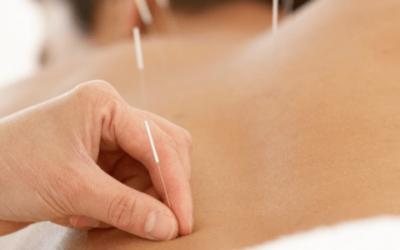 Acupuncture – Find a Therapist Online – UK Therapy Hub