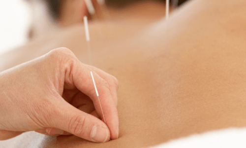 Acupuncture – Find a Therapist Online – UK Therapy Hub
